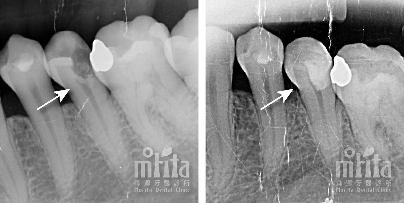 A before and after x-ray of a person 's teeth