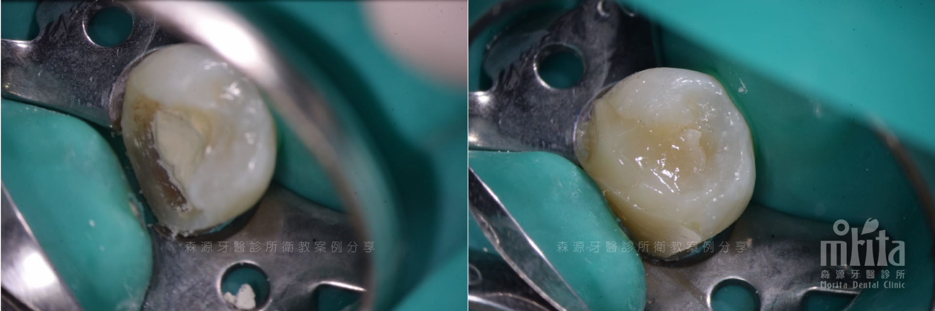 A close up of a tooth with a rubber band around it.