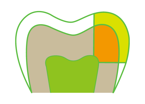 A drawing of a tooth with different colored sections of it.
