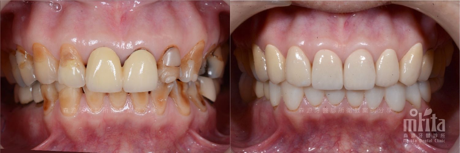 A before and after picture of a person 's teeth.