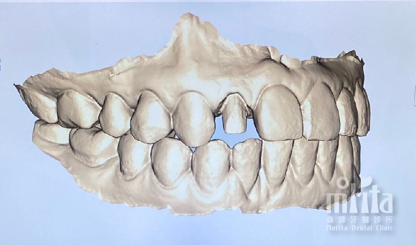 A computer generated image of a person 's teeth on a blue background.