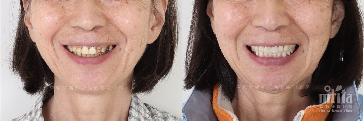 A before and after photo of a woman 's smile.