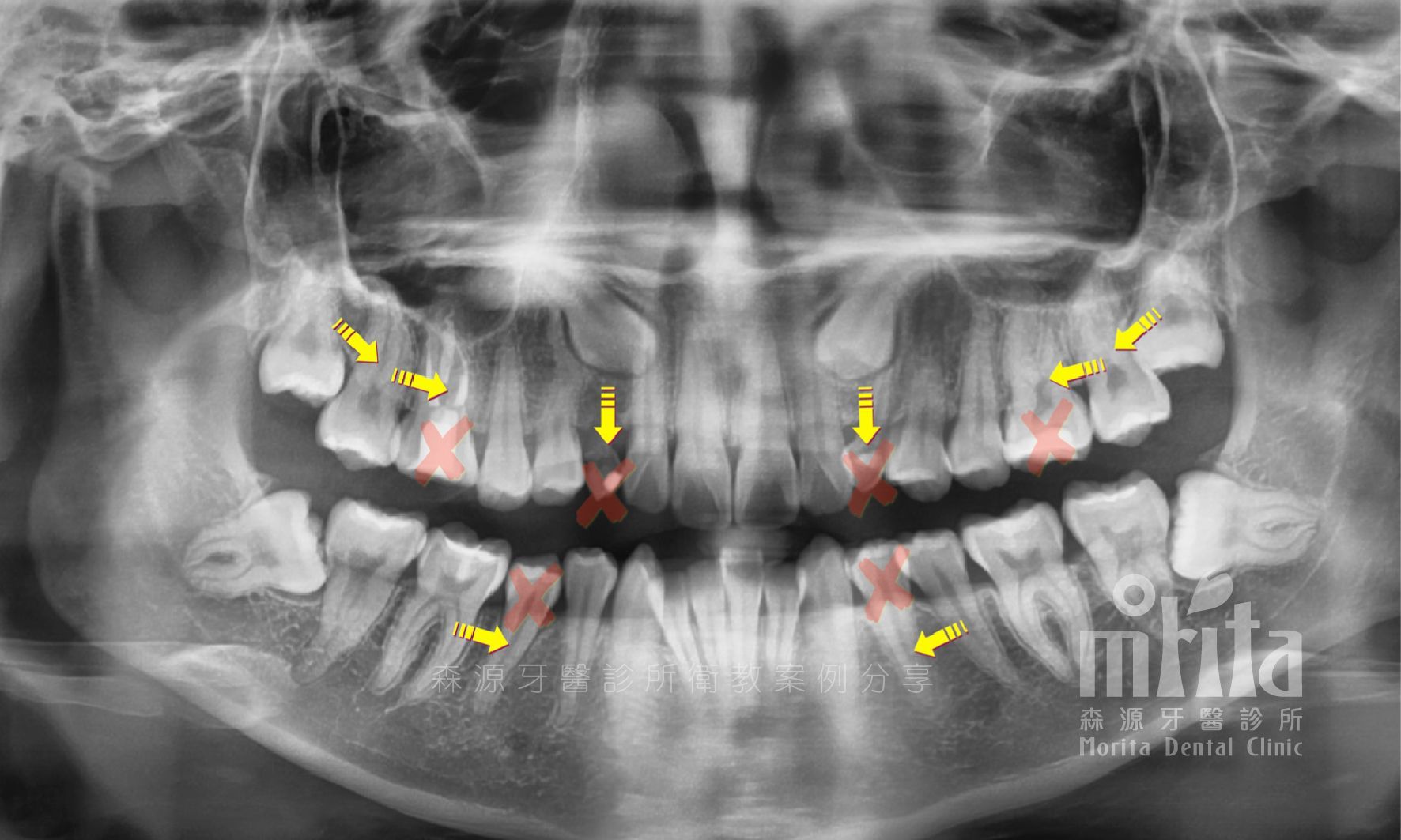 An x-ray of a person 's teeth with yellow arrows pointing to the teeth.