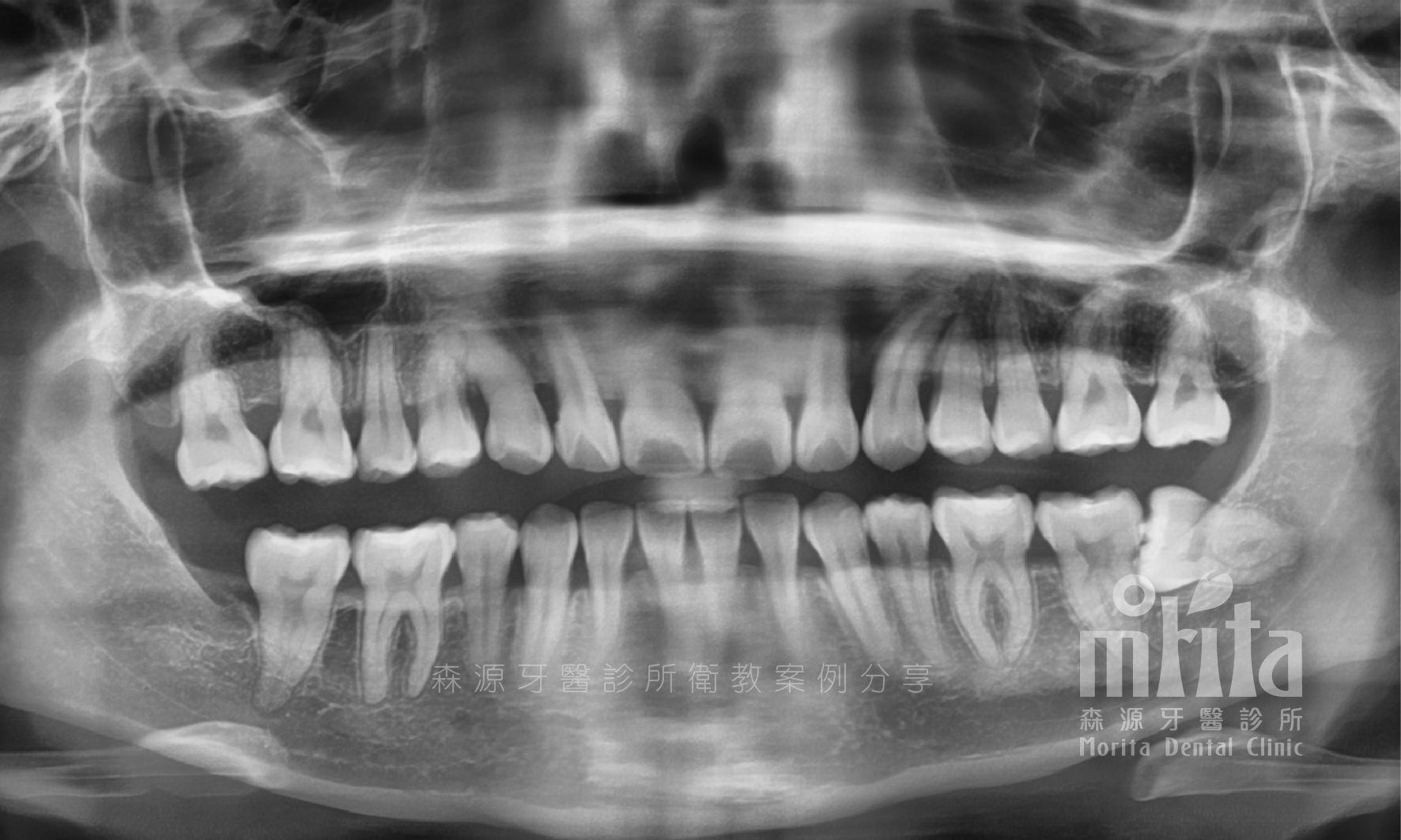 A black and white x-ray of a person 's teeth.