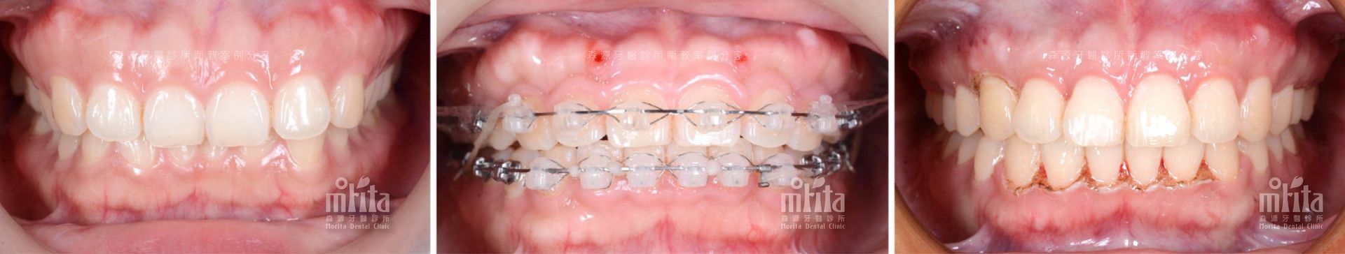 A close up of a person 's teeth with braces on them.