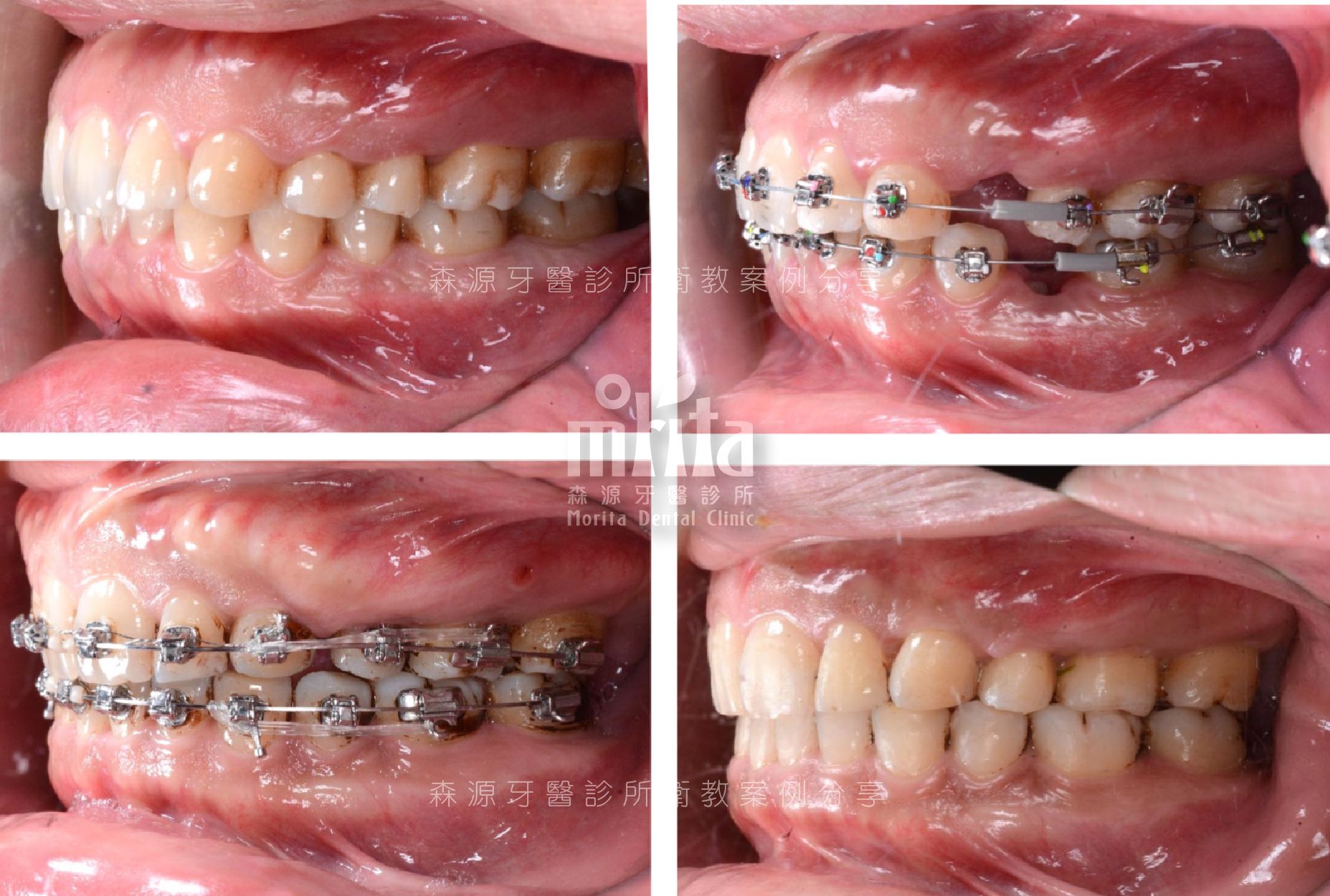 A close up of a person 's teeth with braces on them