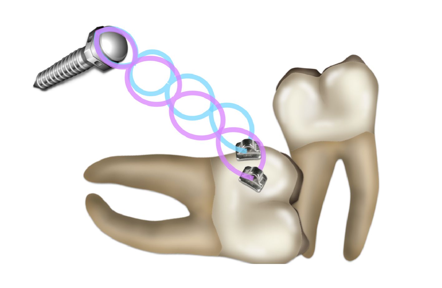 A diagram of a tooth with a screw in it