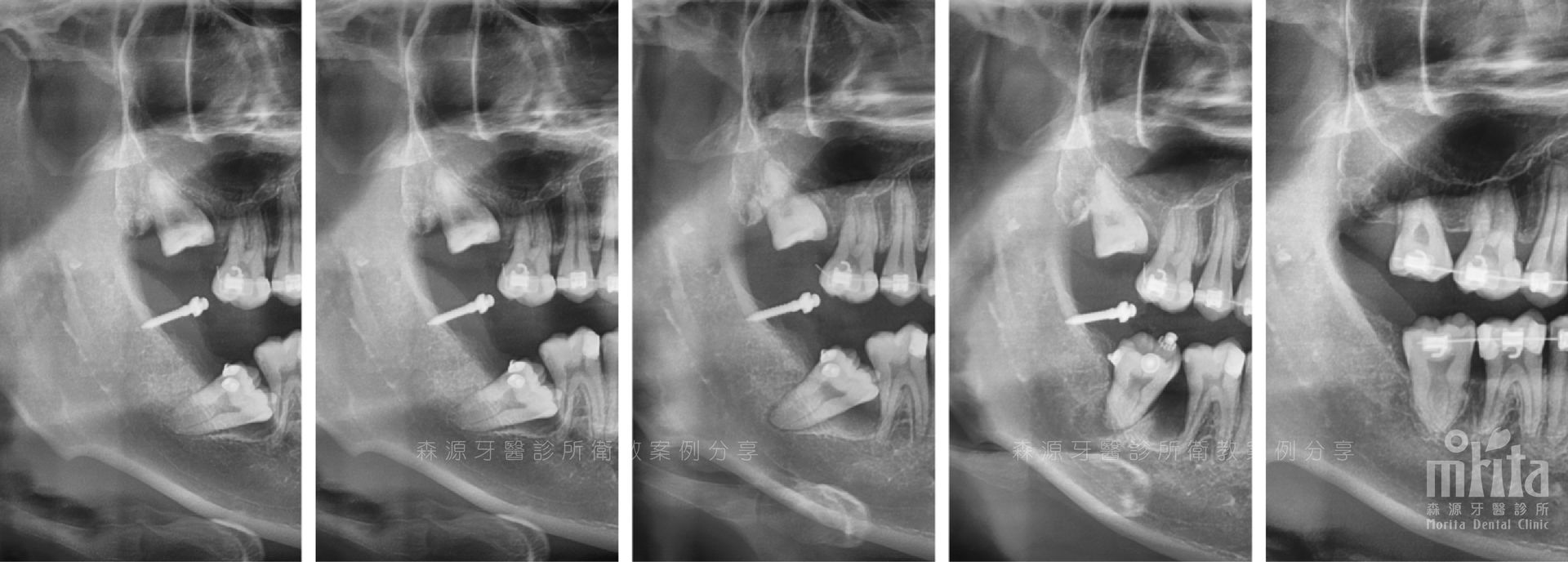 A black and white x-ray of a person 's teeth.