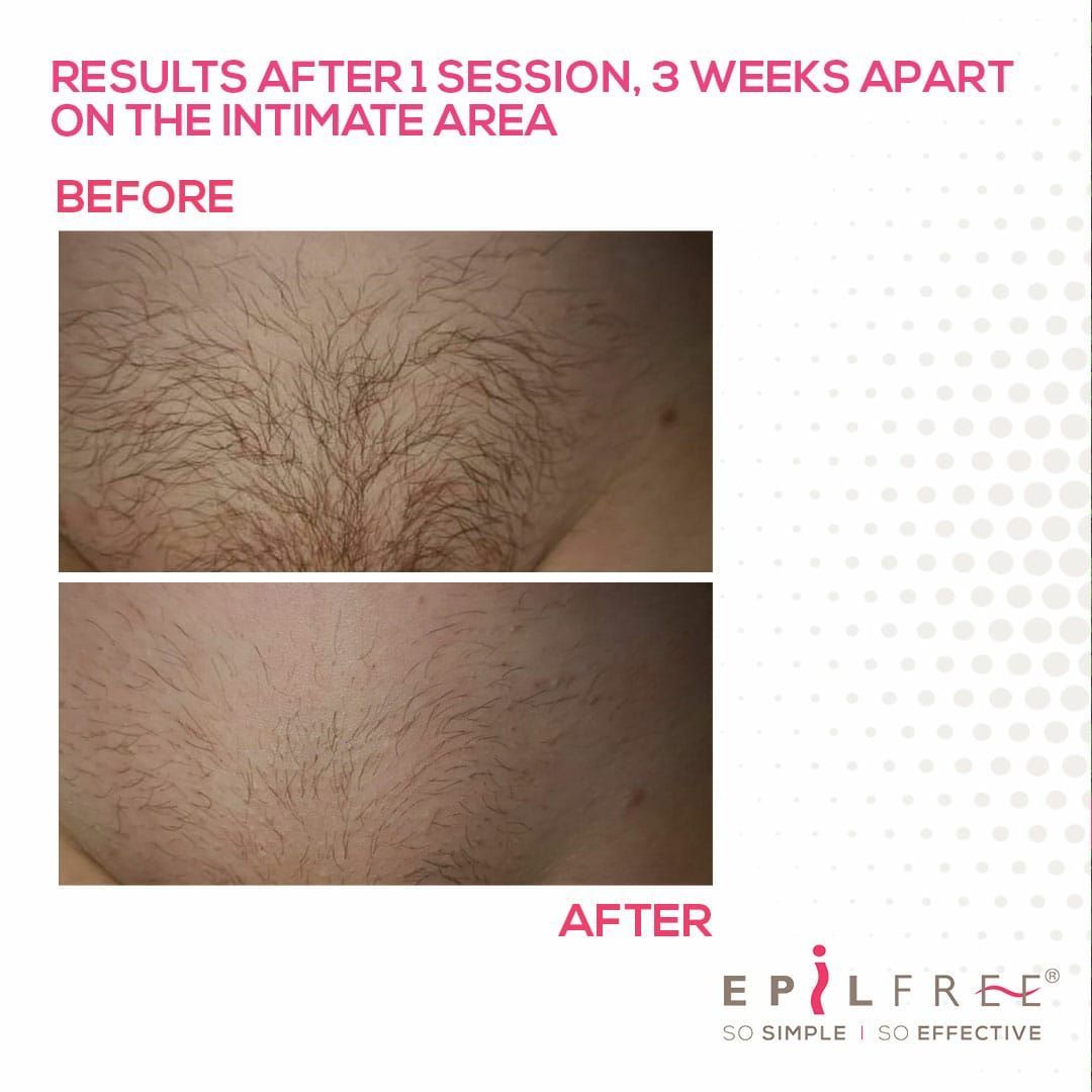 Results after 1 session 3 weeks apart on the intimate area