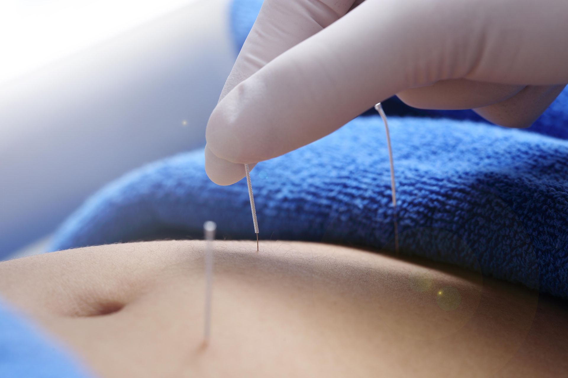 Gloved hand inserting acupuncture needles into skin near a blue towel