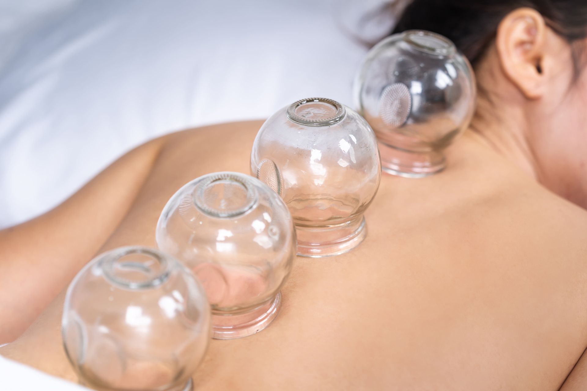 Glass cups used for cupping therapy on a person’s back Glass cups used for cupping therapy on a person’s back