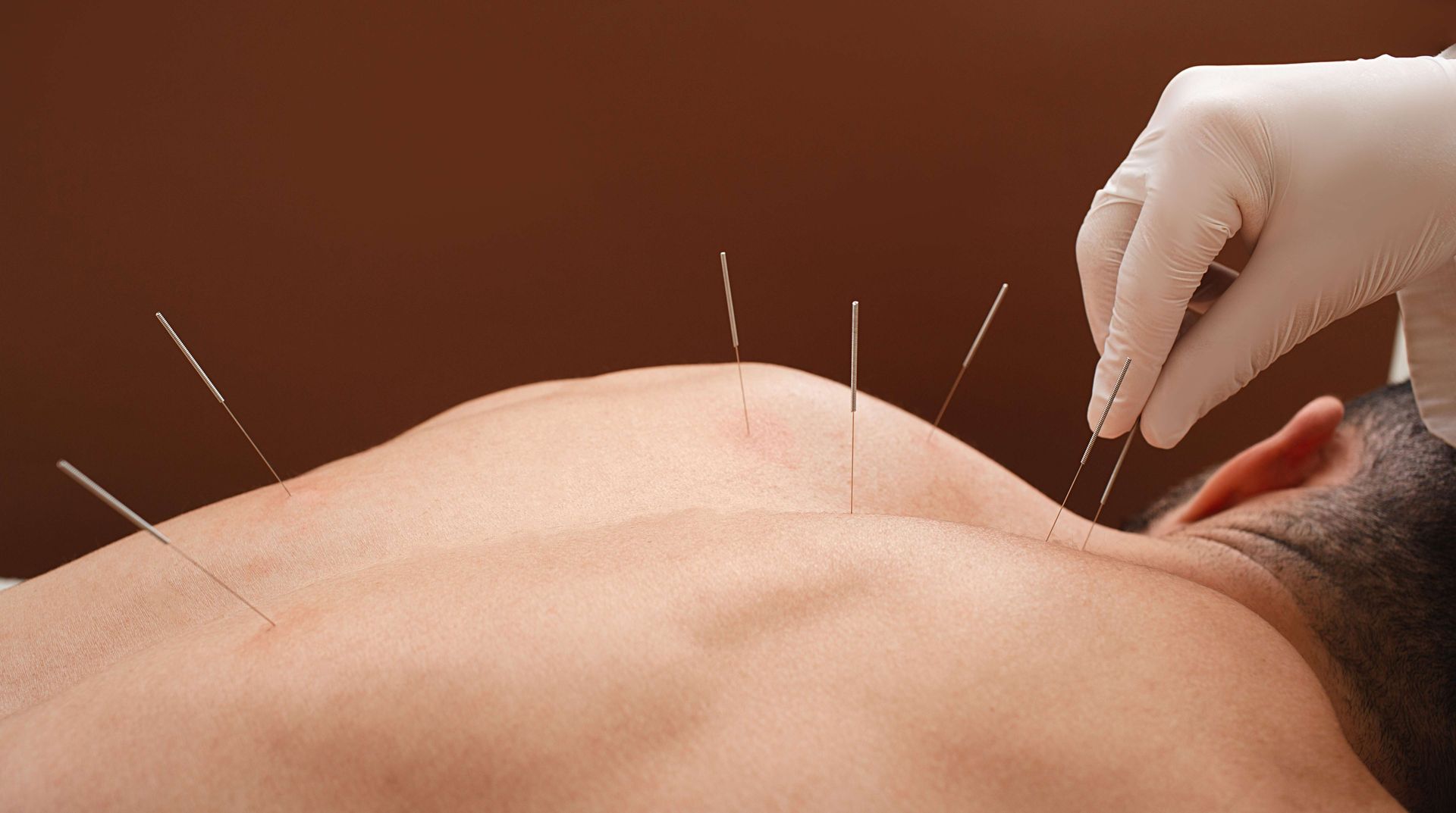 Acupuncture needles inserted along a person’s bare upper back and neck