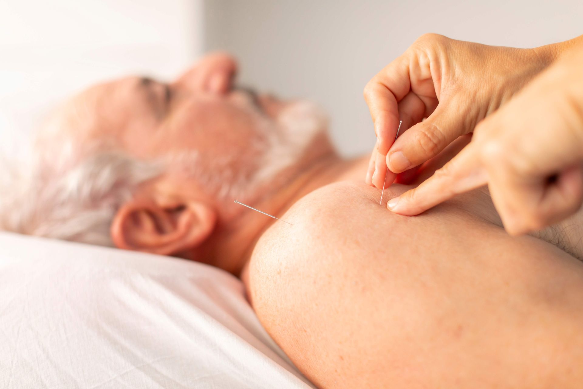 Acupuncture treatment on a patient’s shoulder by a practitioner’s hand