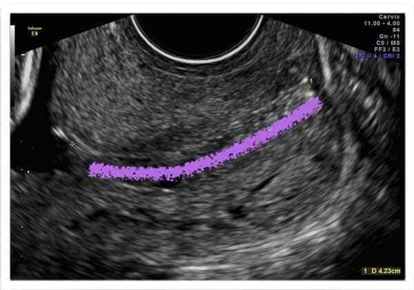 Medicina Fetal Avanzada – Evaluación de riesgo de parto prematuro