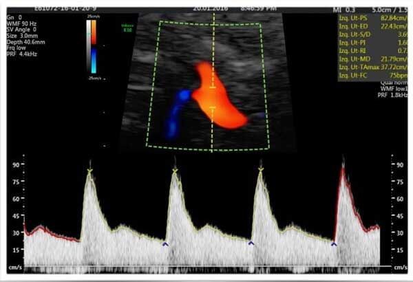 Medicina Fetal Avanzada – La Ecografía Doppler de arterias uterinas