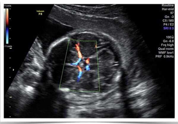 Medicina Fetal Avanzada – Doppler