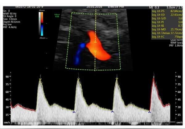 Medicina Fetal Avanzada – ecografía doppler
