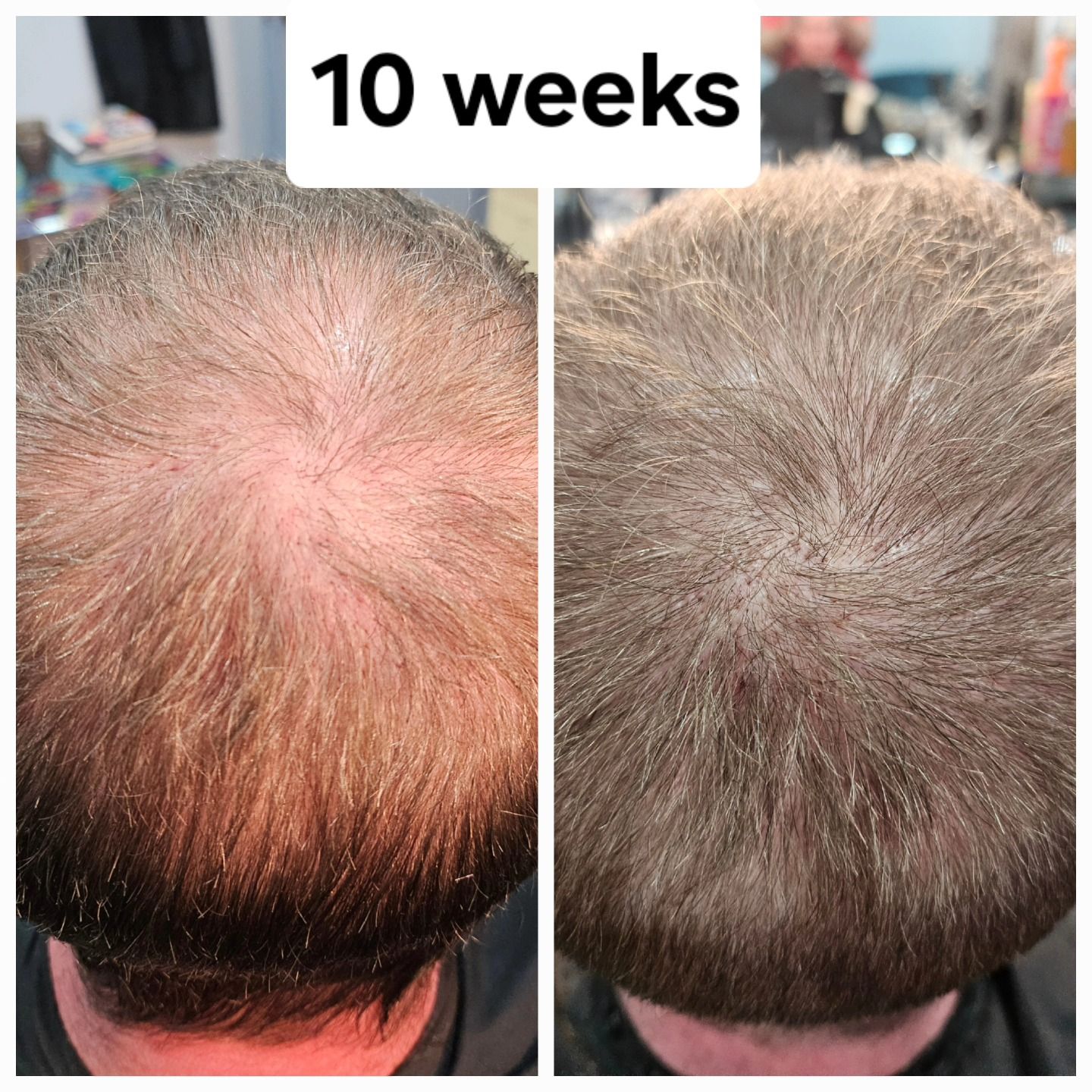 Side-by-side scalp photos showing reduced thinning and denser hair after 10 weeks