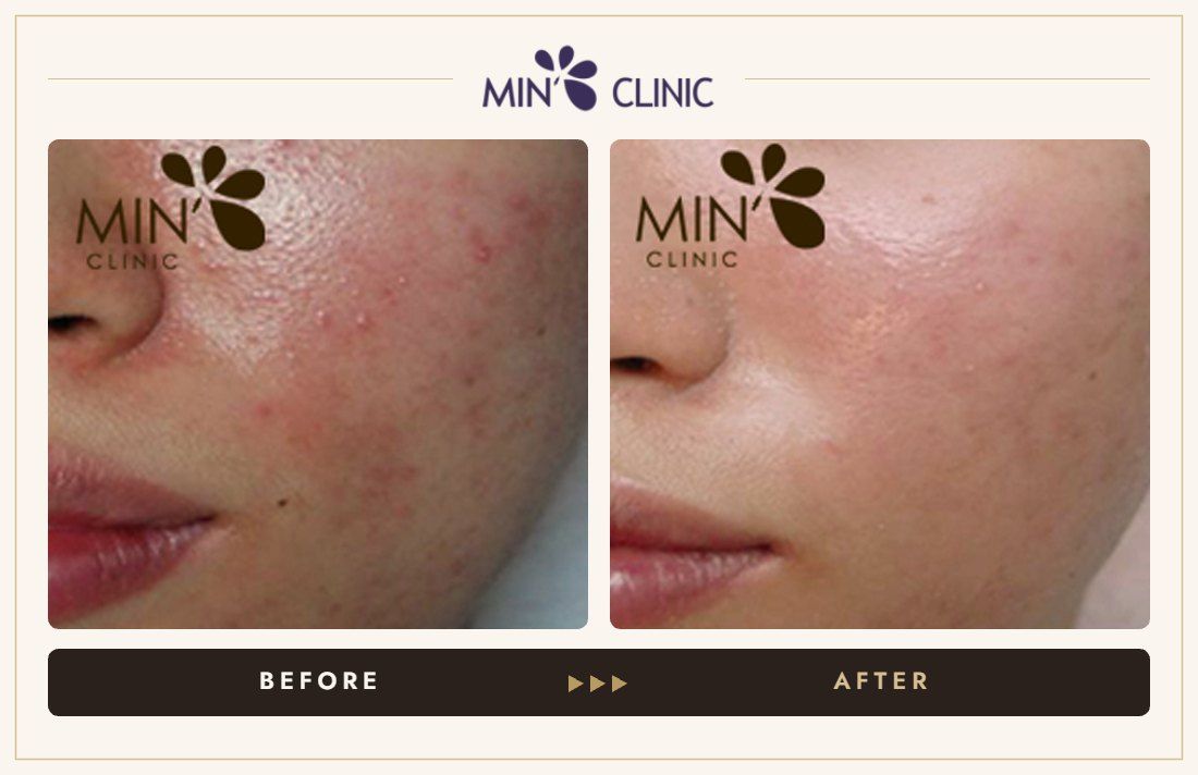 Acne before and after, case 30 – MIN Clinic Seoul