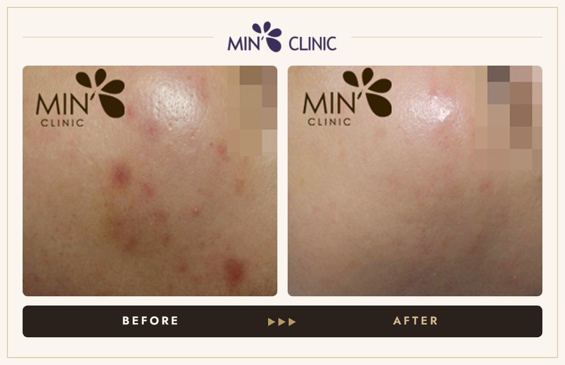 Acne before and after, case 31 – MIN Clinic Seoul