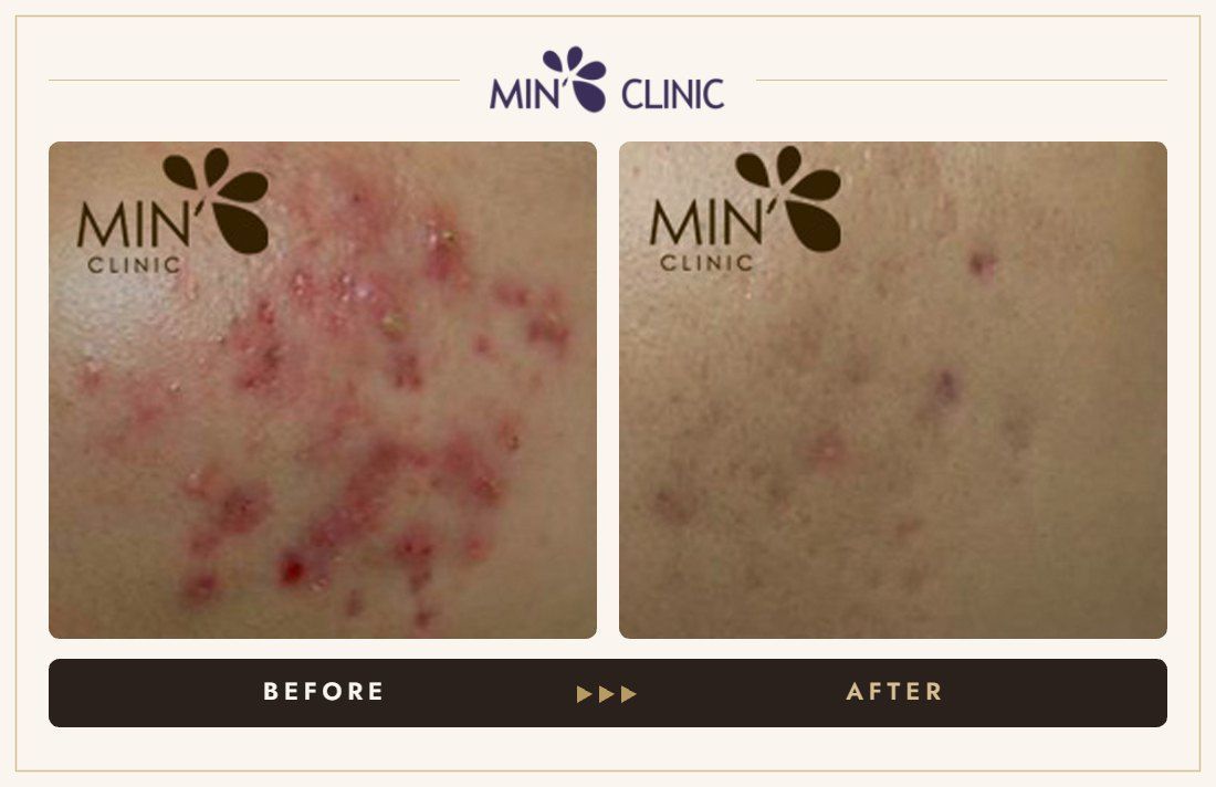 Acne before and after, case 32 – MIN Clinic Seoul