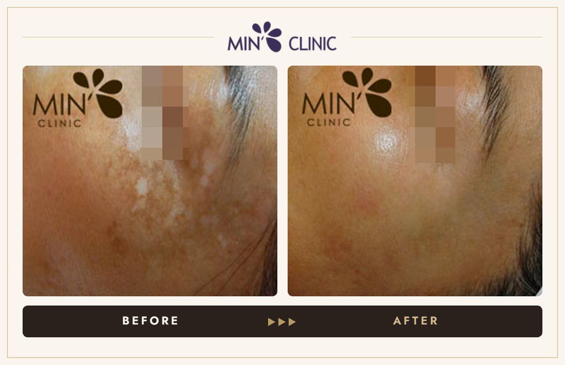 Pigmentation before and after, case 7 – MIN Clinic Seoul