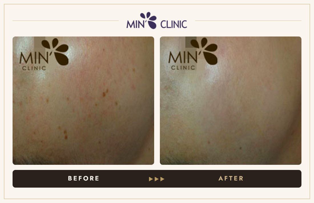 Pigmentation before and after, case 8 – MIN Clinic Seoul