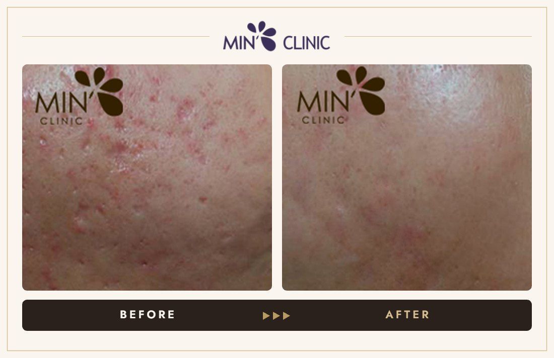 Pores before and after, case 3 – MIN Clinic Seoul