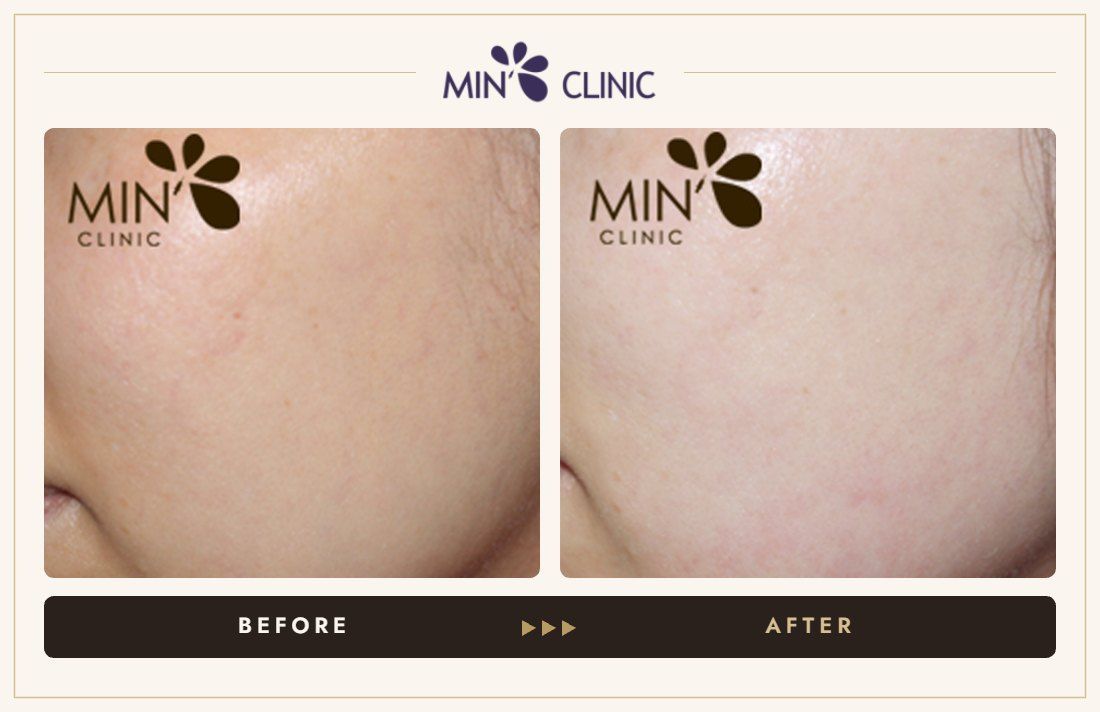 Brightening before and after, case 1 – MIN Clinic Seoul