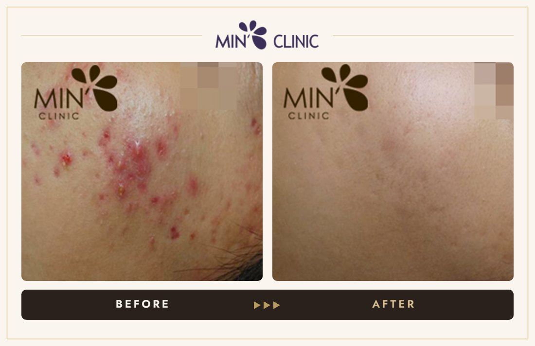 Acne before and after, case 33 – MIN Clinic Seoul