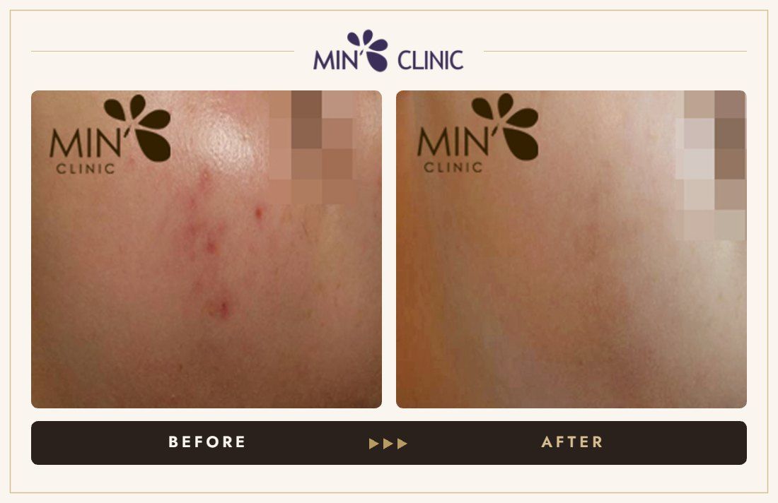 Acne before and after, case 34 – MIN Clinic Seoul