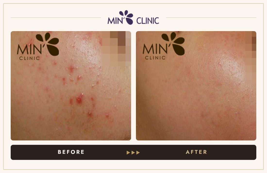 Acne before and after, case 35 – MIN Clinic Seoul