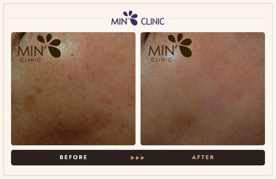 Pigmentation before and after, case 9 – MIN Clinic Seoul
