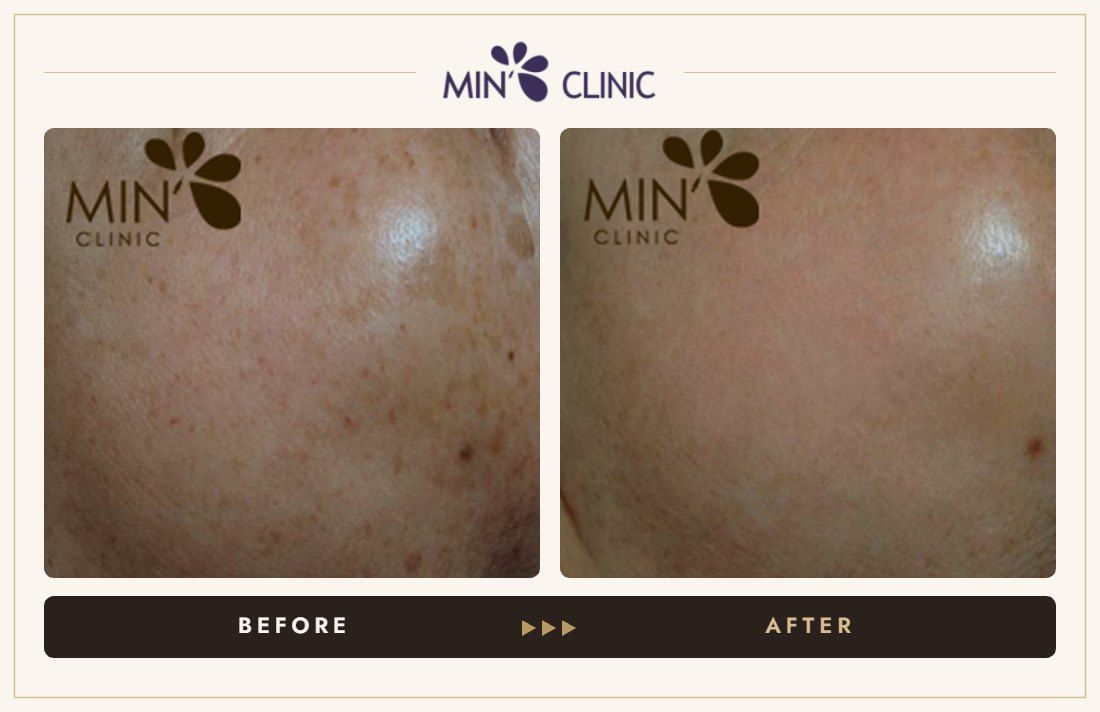 Pigmentation before and after, case 10 – MIN Clinic Seoul