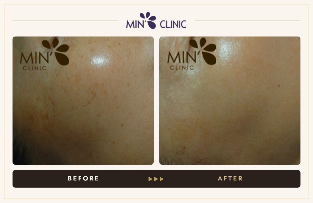 Pigmentation before and after, case 11 – MIN Clinic Seoul