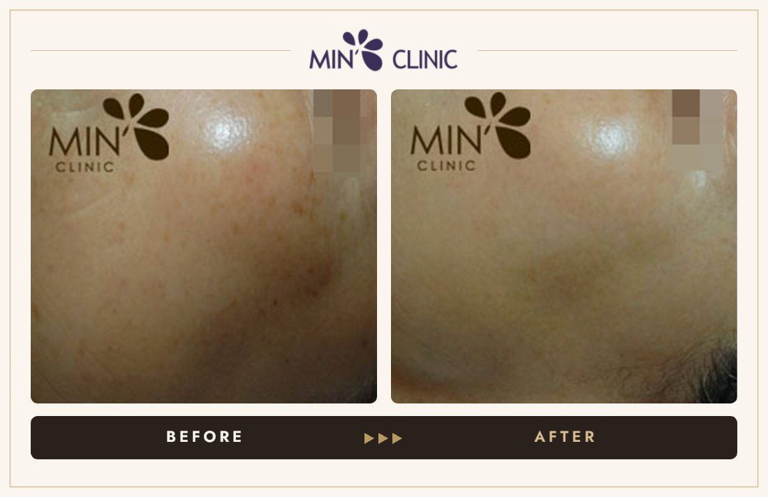 Pigmentation before and after, case 12 – MIN Clinic Seoul