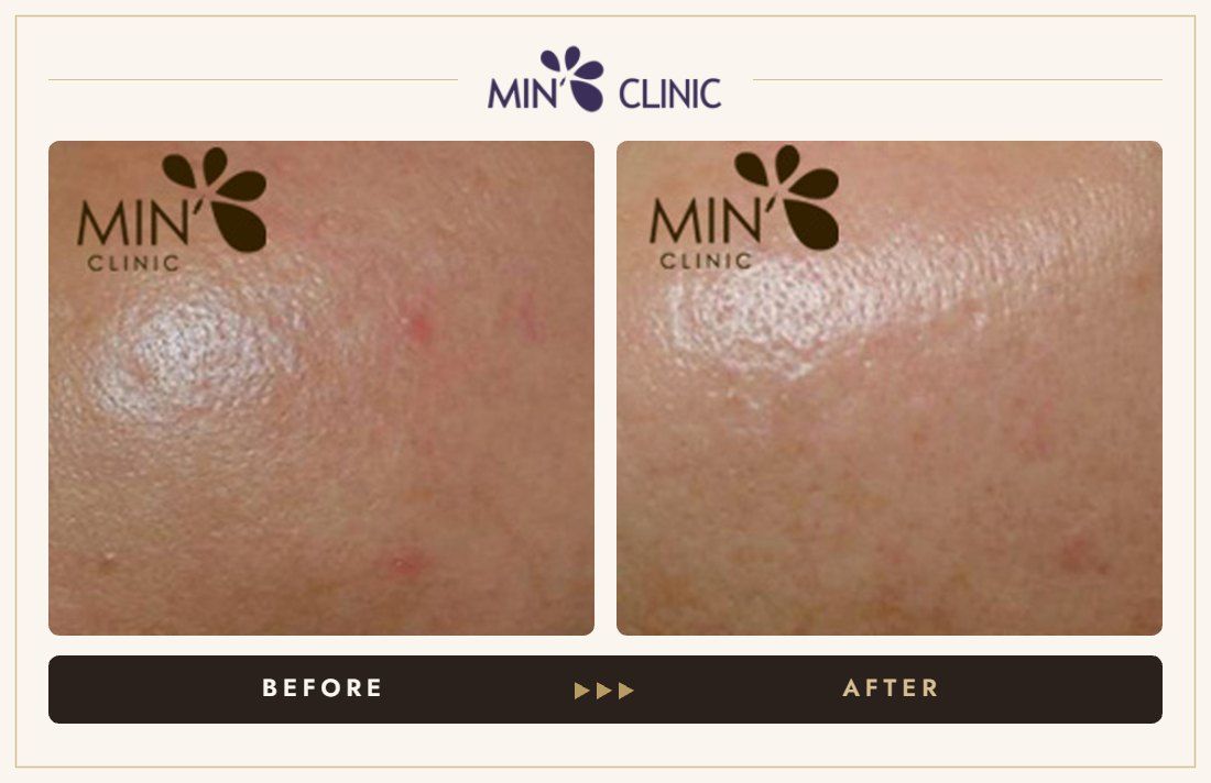 Acne before and after, case 36 – MIN Clinic Seoul