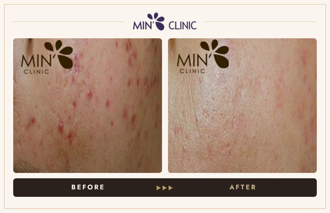 Acne before and after, case 37 – MIN Clinic Seoul