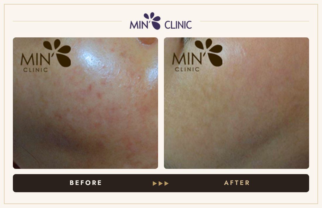 Acne before and after, case 38 – MIN Clinic Seoul