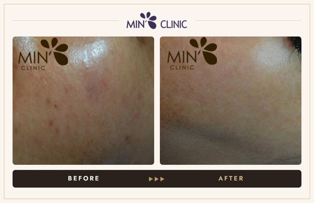 Acne before and after, case 39 – MIN Clinic Seoul