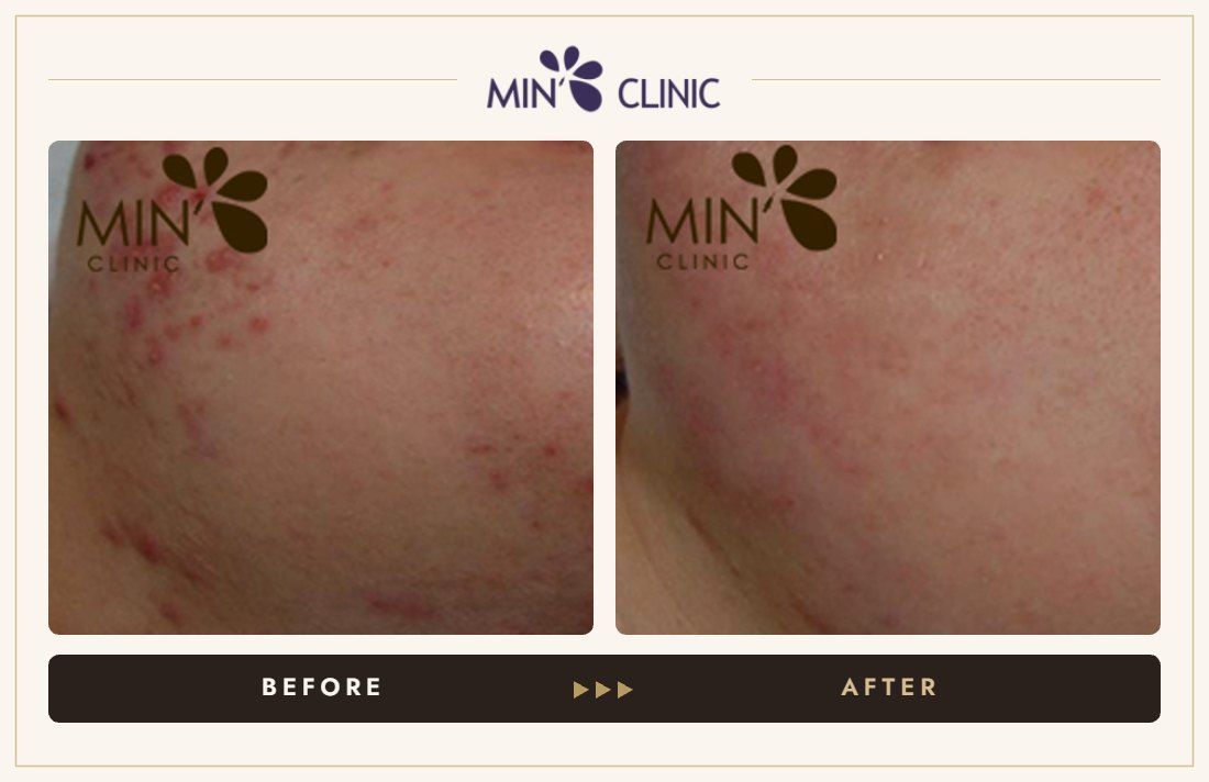 Acne before and after, case 40 – MIN Clinic Seoul