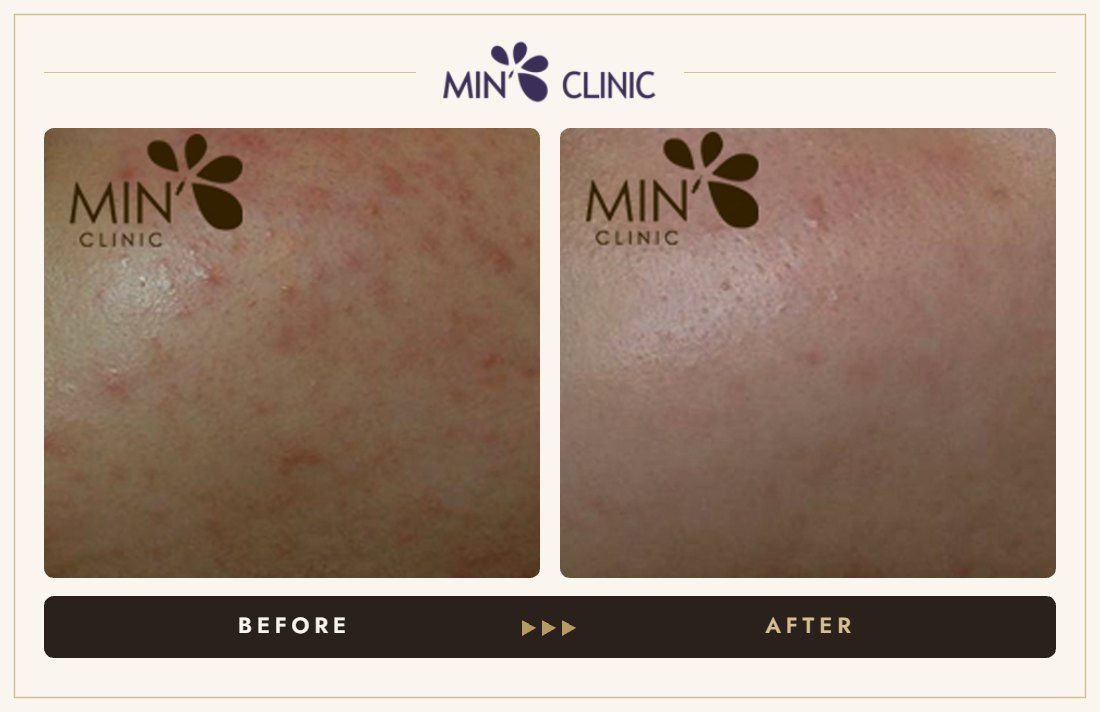 Acne before and after, case 41 – MIN Clinic Seoul