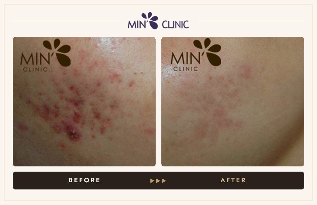 Acne before and after, case 42 – MIN Clinic Seoul