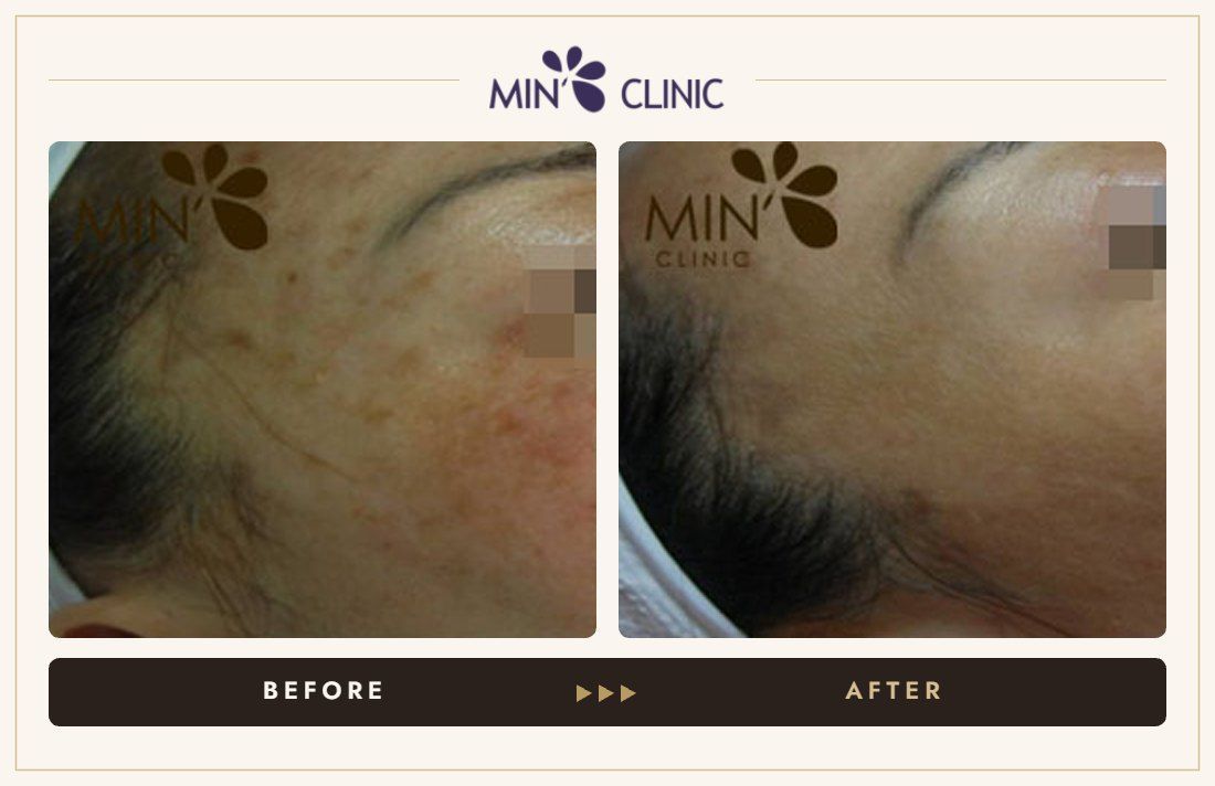 Pigmentation before and after, case 13 – MIN Clinic Seoul