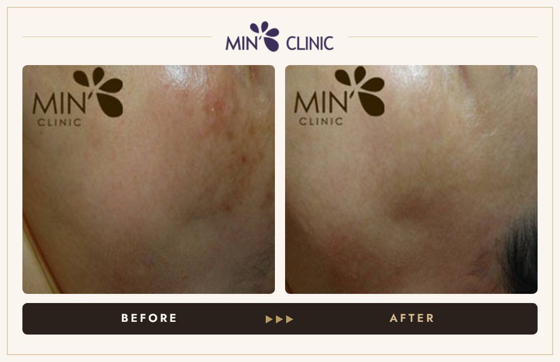 Pigmentation before and after, case 14 – MIN Clinic Seoul
