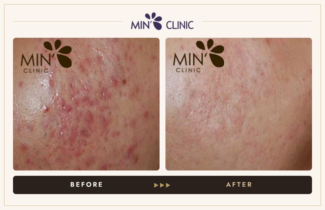 Acne before and after, case 43 – MIN Clinic Seoul