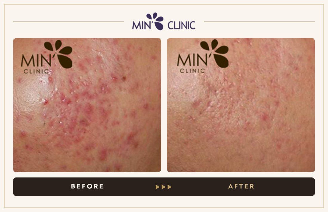 Acne before and after, case 44 – MIN Clinic Seoul