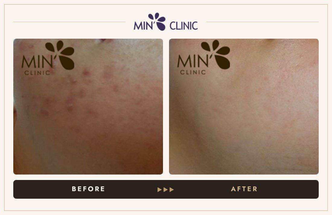 Acne before and after, case 45 – MIN Clinic Seoul