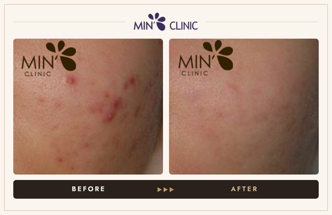 Acne before and after, case 46 – MIN Clinic Seoul