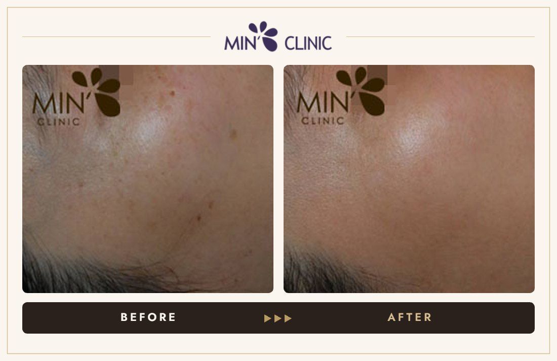 Pigmentation before and after, case 15 – MIN Clinic Seoul